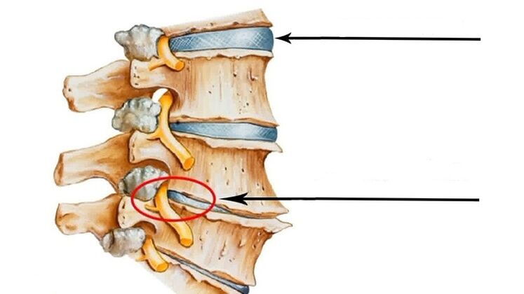 ozljeda kralježnice u slučaju cervikalne osteohondroze