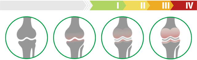 Kliničke faze artroze zgloba koljena (stupanj artroze zgloba koljena)