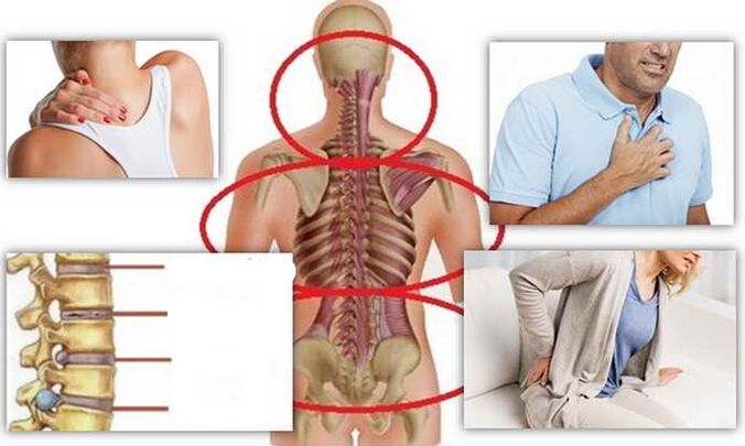 Mjesta bolesti za osteohondrozu