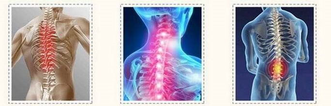 Osteohondrosin lezije kralježnice